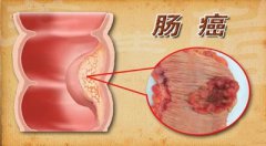 腸癌的早期癥狀有哪些？警惕這些危險信號！